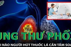 Khi nào nên tầm soát ung thư phổi cho người hút thuốc lá?