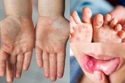 Đã có thuốc điều trị bệnh tay chân miệng nặng