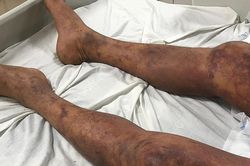 Người đàn ông tím đen toàn thân sau chế biến và ăn thịt lợn ốm