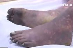 Bị sốc nhiễm khuẩn, suy đa tạng sau khi giết mổ và ăn thịt lợn ốm