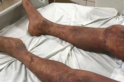 Rùng mình với cơ thể tím đen của người đàn ông sau khi giết mổ và ăn thịt lợn ốm