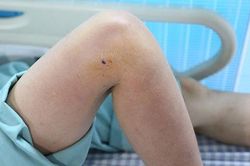 Người phụ nữ nhập viện sau khi bị... gà mổ vào chân