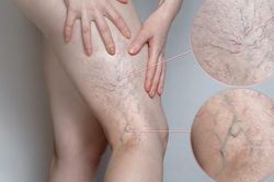 Bệnh suy giãn tĩnh mạch có thể gây tử vong