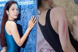 Nam Em lộ rõ thân hình gầy gò, nhiều vết bầm tím trên cơ thể khiến fan lo lắng