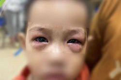 Cảnh báo dịch đau mắt đỏ ở trẻ em kèm theo nhiều biến chứng