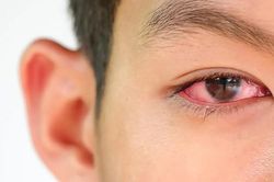 Hà Nội xuất hiện dịch đau mắt đỏ lây lan nhanh
