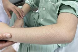 Lạm dụng thuốc xịt mũi, 2 anh em bị suy thượng thận