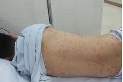 Một người đàn ông tử vong do nhiễm liên cầu lợn