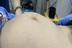 Bé gái 9 tuổi với khối u buồng trứng khổng lồ