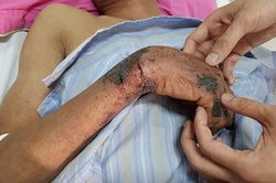 Cảnh báo sốc nhiễm trùng, tử vong vì liên cầu lợn chỉ sau vài giờ nhập viện