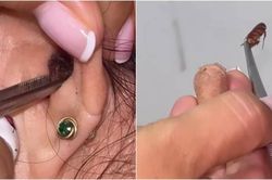 Đau âm ỉ trong tai, sốc nặng phát hiện 'quái thú' ẩn náu