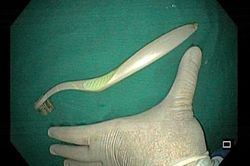 Cô gái nuốt chiếc bàn chải đánh răng dài hơn 20cm