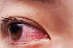 Số ca mắc bệnh đau mắt đỏ tăng nhanh, TP.HCM khẩn trương tìm nguyên nhân