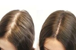 Kích thích tóc mọc nhanh bằng các biện pháp đơn giản tại nhà