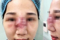 2 phụ nữ bị biến chứng và trộm hết tài sản sau khi được đưa vào khách sạn tiêm filler 'chui'