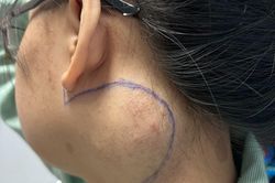 Cô gái 18 tuổi 'sống chung' với khối u lớn ở cổ suốt 7 năm