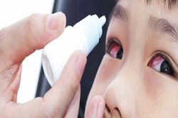 TP Hồ Chí Minh: Đã xác định được tác nhân gây bệnh đau mắt đỏ