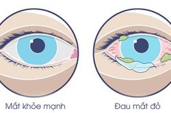 Xác định nguyên nhân bùng phát bệnh đau mắt đỏ