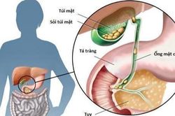 Sỏi túi mật không triệu chứng: Khi nào cần phẫu thuật để tránh biến chứng