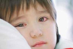 Những điều cần biết khi dịch đau mắt đỏ đang lan rộng