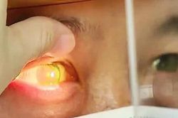 Nguy cơ bùng phát dịch đau mắt đỏ