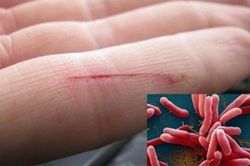 Thanh Hóa: Ghi nhận trường hợp mắc 'khuẩn ăn thịt người' chưa rõ nguồn