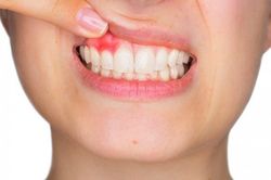 Dấu hiệu ở miệng cảnh báo gan nhiễm mỡ