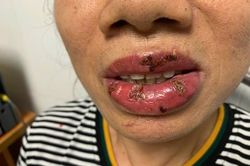 Mất tiền xăm môi, người phụ nữ nhận lại đôi môi bị nhiễm trùng