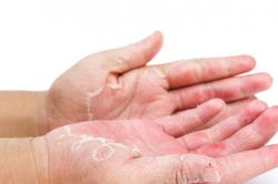 Viêm da cơ địa và phương pháp cải thiện như nào?