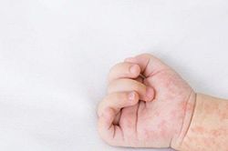 Bé gái 1 tuổi phải nhập viện cấp cứu sau nụ hôn của người họ hàng