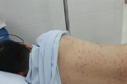 Người đàn ông la hét, kích thích do nhiễm liên cầu lợn