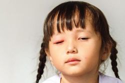 Bệnh đau mắt đỏ lây nhanh ở trẻ dưới 5 tuổi