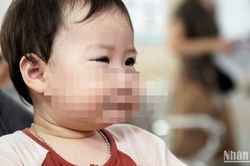 Đau mắt đỏ ở trẻ em: Khi nào cần đưa trẻ đi khám?