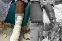 Người đàn ông phát hiện mắc đái tháo đường chỉ từ một vết xước