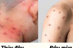 Hướng dẫn phân biệt bệnh ĐẬU MÙA KHỈ và thủy đậu