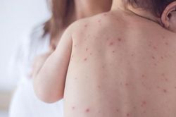Trẻ em có thể mắc bệnh ĐẬU MÙA KHỈ không, cần làm gì nếu có triệu chứng nghi ngờ?