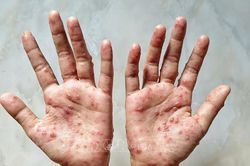 Những triệu chứng điển hình của bệnh ĐẬU MÙA KHỈ