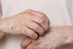 Đồng Nai ghi nhận ca mắc đậu mùa khỉ đầu tiên