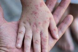 Đồng Nai: Xuất hiện ca mắc bệnh đậu mùa khỉ