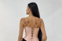 Hoàng Thùy lộ rõ sức khỏe đáng lo, lưng chẳng chịt vết bầm đỏ