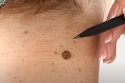 Phát hiện ung thư da sau nhiều năm không thăm khám