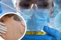 Giám sát chặt để bệnh đậu mùa khỉ không lây nhiễm chéo