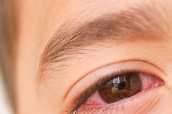 Nhìn người mắc bệnh đau mắt đỏ có bị lây?