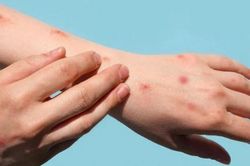 TPHCM: 8 người tiếp xúc gần với ca mắc đậu mùa khỉ, 1 người mắc bệnh