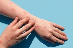 TP Hồ Chí Minh phát hiện 2 trường hợp mắc bệnh đậu mùa khỉ