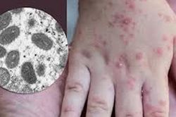 Ghi nhận 2 ca đậu mùa khỉ, Bộ Y tế yêu cầu tăng cường giám sát, điều trị, không để lây nhiễm chéo