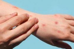 Hướng dẫn phòng bệnh, điều trị bệnh đậu mùa khỉ