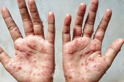 Phát hiện thêm 1 trường hợp mắc đậu mùa khỉ ở TPHCM