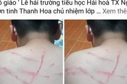 Cô giáo dùng roi tre, đánh bầm tím lưng học sinh vì không làm bài tập