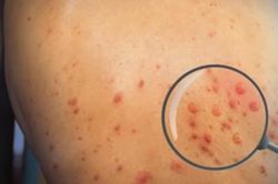 Kết quả giải mã gene ca bệnh đậu mùa khỉ đầu tiên phát hiện tại TPHCM